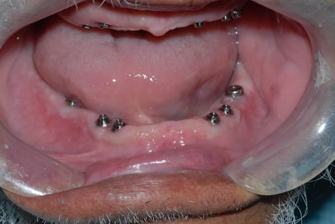 dental implant case study3