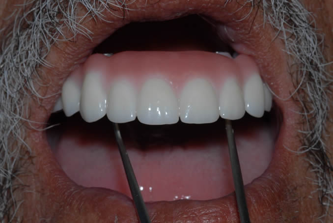 dental implant case study4