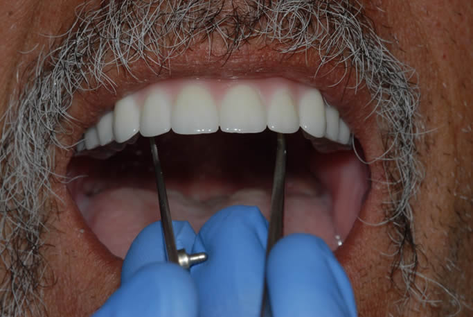 dental implant case study5