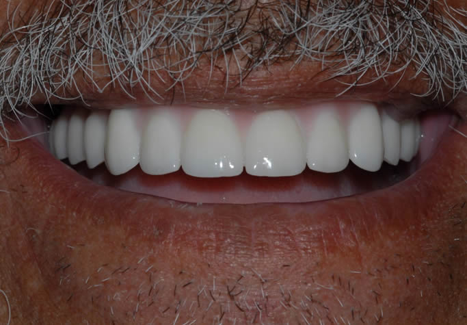 dental implant case study6