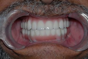 dental implant case study7