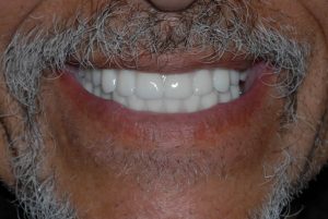 dental implant case study8