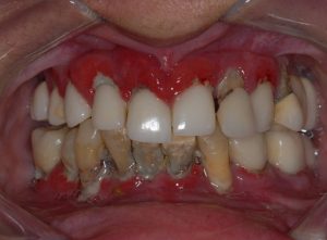 full mouth implants ALL ON 6 Technique