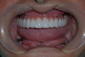full mouth implants ALL ON 6 Technique
