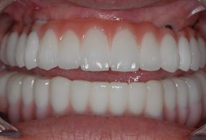 Featured All on 4 Case Study Dental Implants..