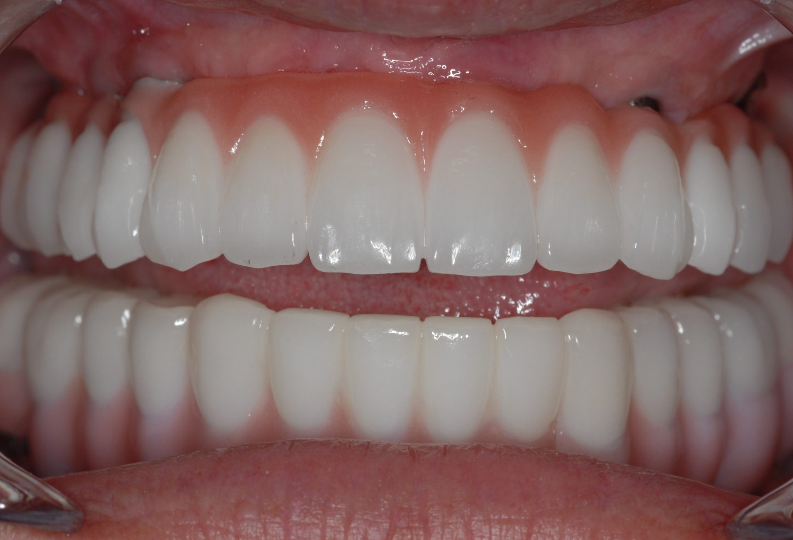 All-On-4 Implant  Featured Case Study 