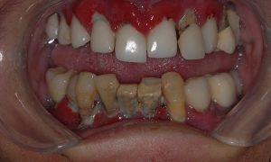 Dental implant all on 4 before case study