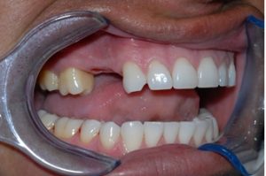 all teeth replacement case study