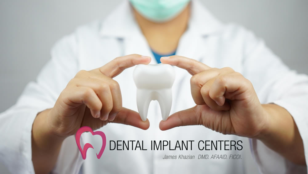 dental implants allon4 banner