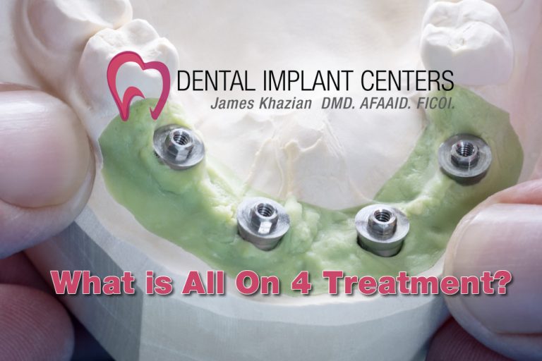 all on 4 dental implant procedure San Diego Dental Implant Centers