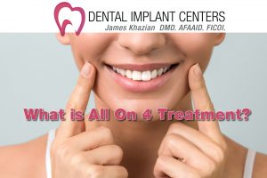 What is All on 4 dental implants?