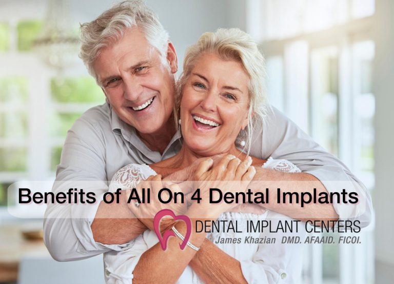 Benefits of All On 4 Dental Implants | San Diego Dental Implant Centers