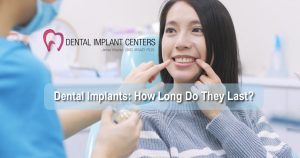 Dental Implants: How Long Do They Last?