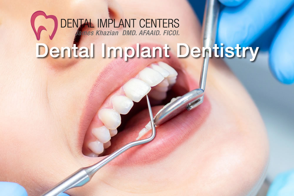 Dental implant dentist san diego