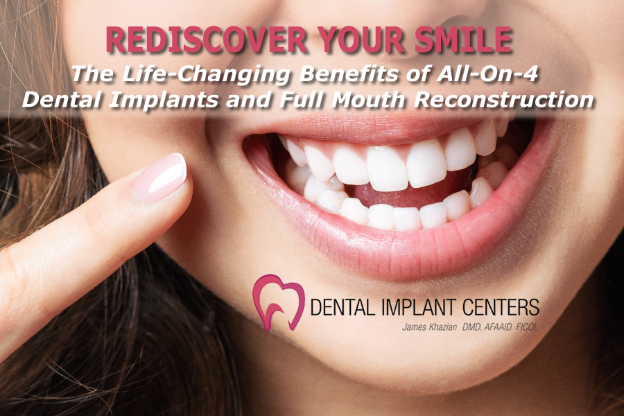 Rediscover Your Smile the Life-Changing Benefits of All-On-4 Dental Implants and Full Mouth Reconstruction