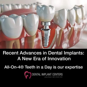 dental implant technology allon4