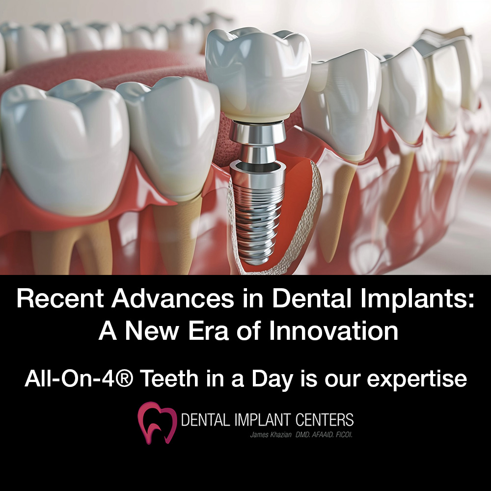 dental implant technology allon4