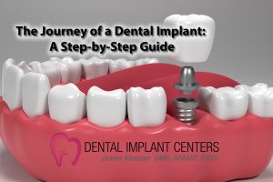 The Journey of a Dental Implant: A Step-by-Step Guide