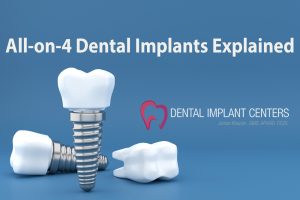 educational dental implant teeth