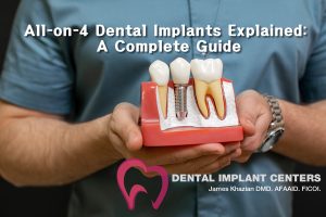 All-on-4 Dental Implants Explained: A Complete Guide