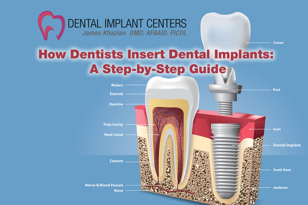 How Dentists Insert Dental Implants: A Step-by-Step Guide