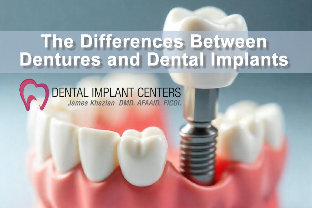 The Differences Between Dentures and Dental Implants