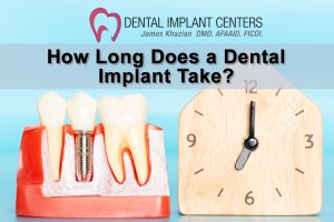 How Long Does Dental Implant Take