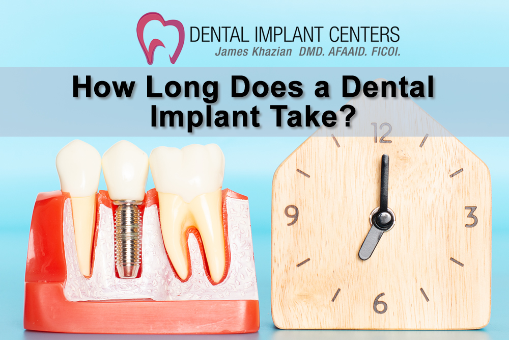 How Long Does Dental Implant Take