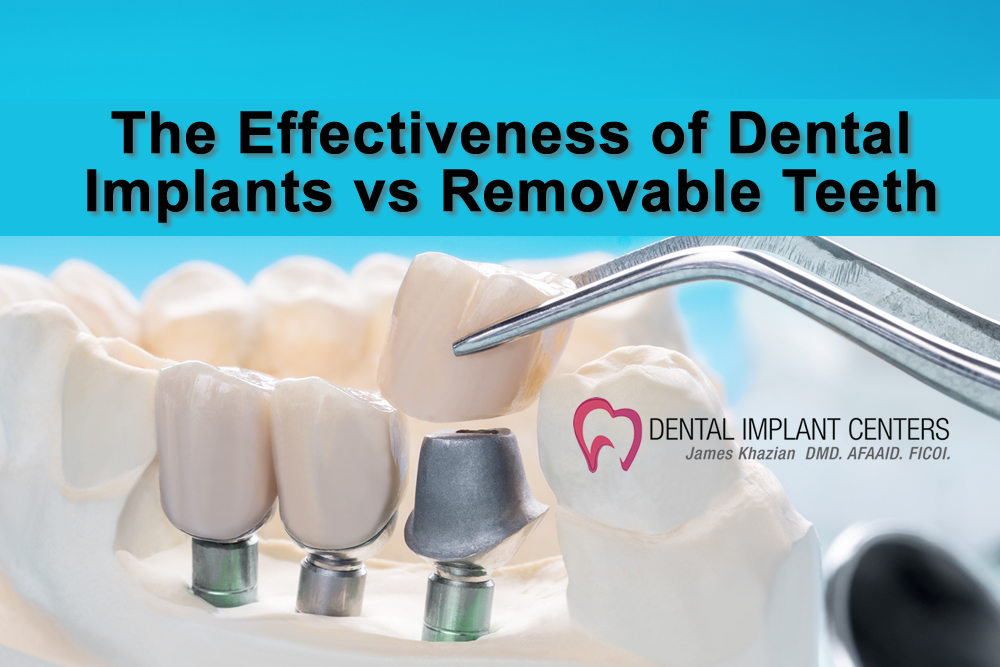 dental implants vs dentures banner