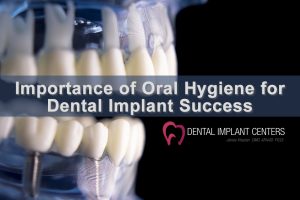 Oral Hygiene Dental Implants