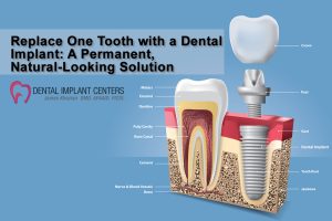 one tooth dental implant