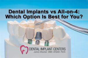 Dental Implants vs All on 4