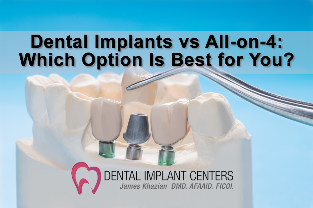 Dental Implants vs All on 4
