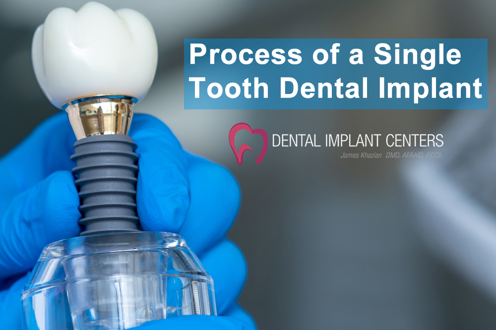 Process Single Tooth Dental Implant