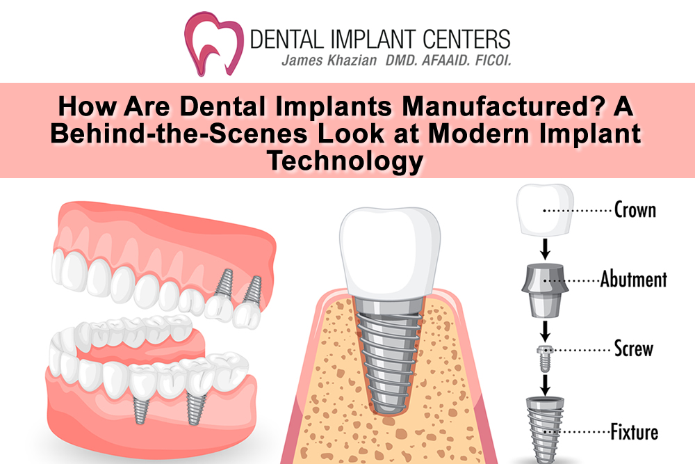How Are Dental Implants Made