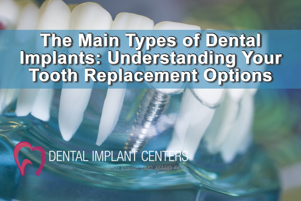 The Main Types of Dental Implants: