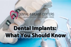dental implants what you should know